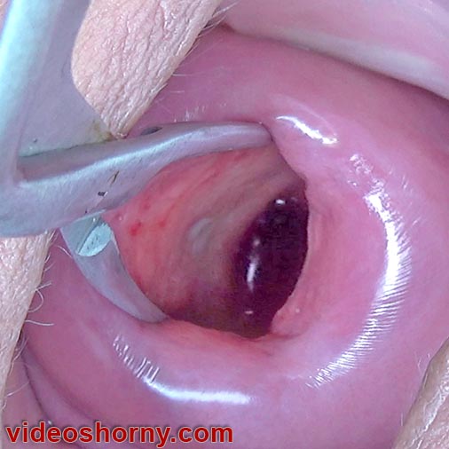 Vidéo de dilatation extrême du col de l’utérus qui l’étire avec une pince à épiler Magill