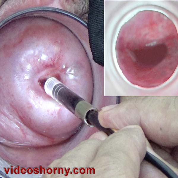 Inspection exam using a japanese endoscopic camera by cervix to watch into uterus