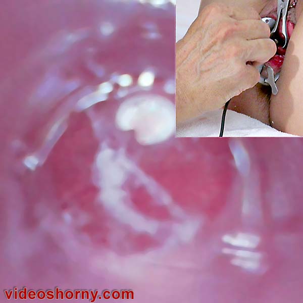 精液と小便を有する女性の膀胱は、内視鏡カメラで見られる