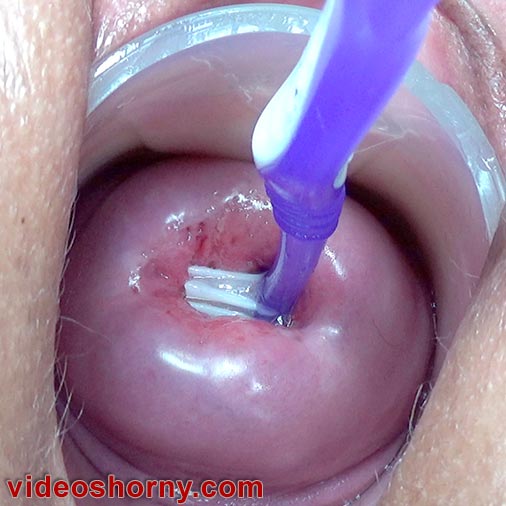 Cervix penetration with toothbrush