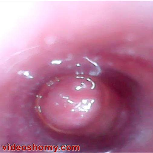 Watch inside peehole with Japanese endoscope camera into the urethra
