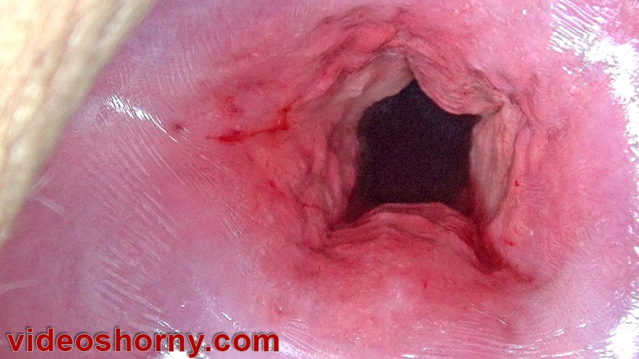 Cervix Dilation Stretching the Uterus with Cervix Penetration