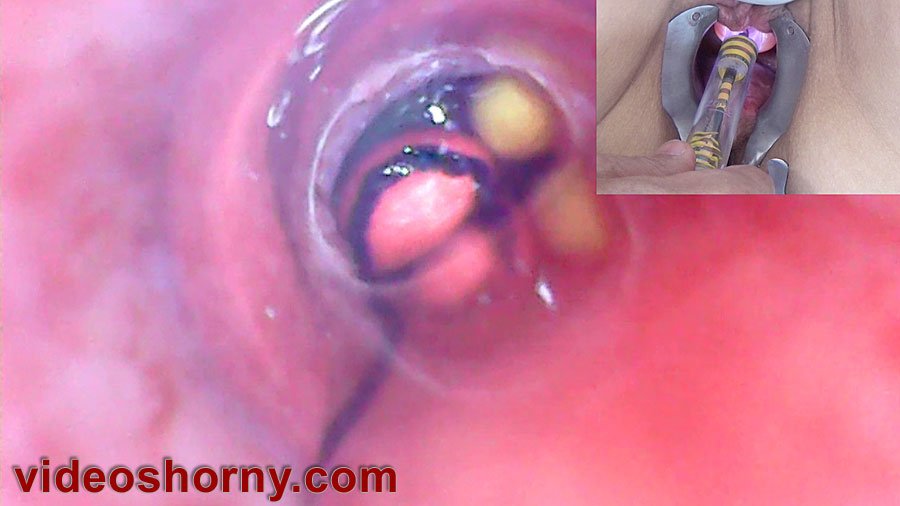 Endoscope Camera sounding peehole in female bladder with balls